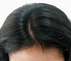 After Hair Restoration