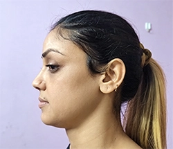 After Hair Restoration