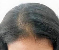 Before Hair Restoration