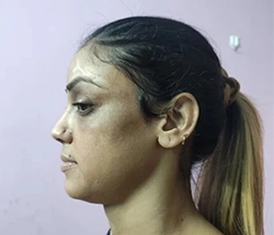 Before Hair Restoration